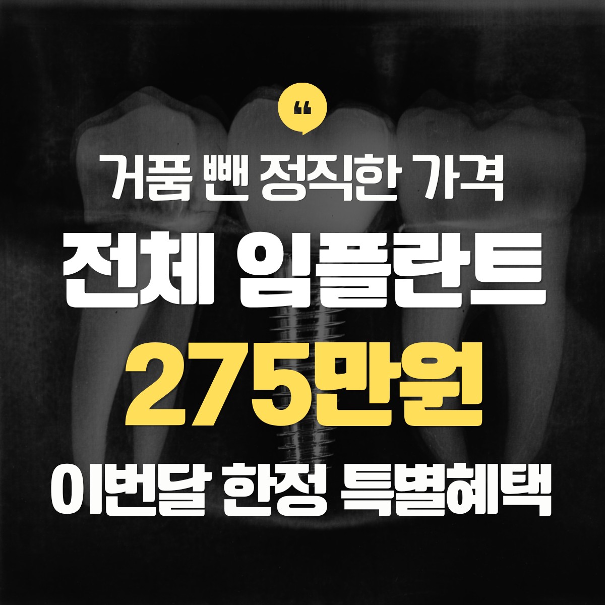 노원구 전체 임플란트 275만원 추천